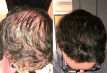 PRP Hair Transplant