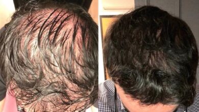 PRP Hair Transplant